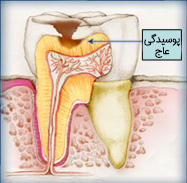 tooth decay